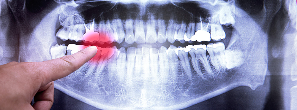 Dental X-ray with Pressure Point