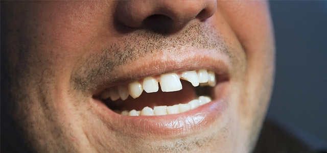 Man with Chipped Tooth
