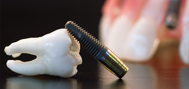Dental Implant Closeup