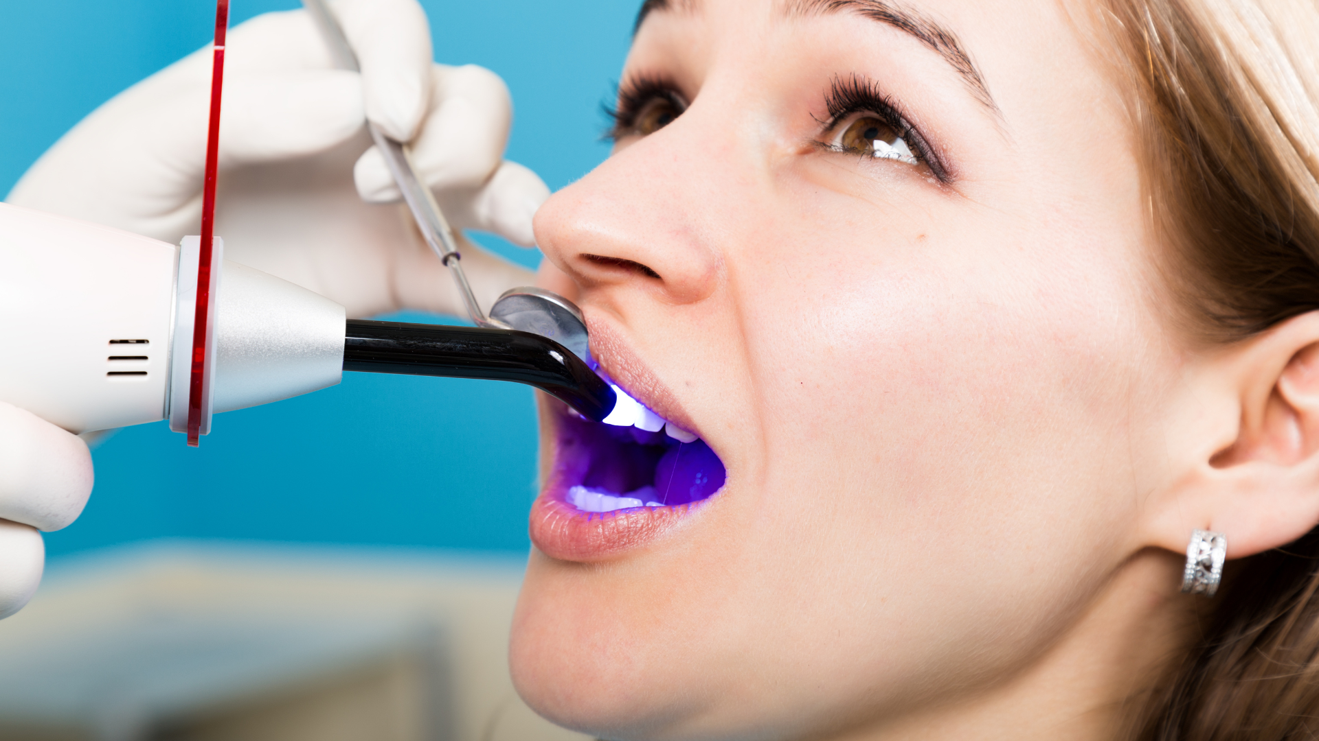 Can dental bonding be whitened?